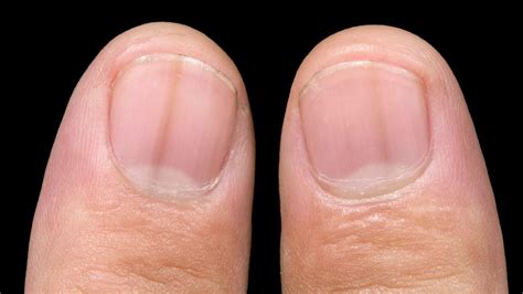 Melanonychia: What Is It, Causes, and More Pale Nails, White Nails ...