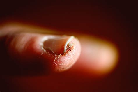 The Surprising Link Between Fingernails and Lung Cancer - Huffington News