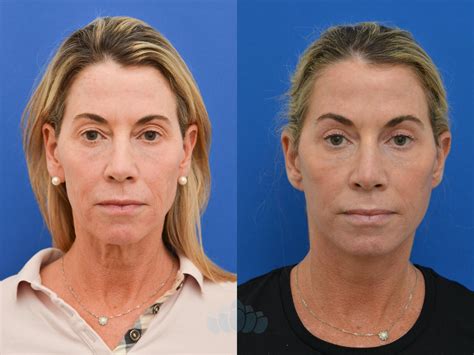 Eyelid Surgery Before and After Photo Gallery | Charlotte, NC | Dilworth Facial Plastic Surgery