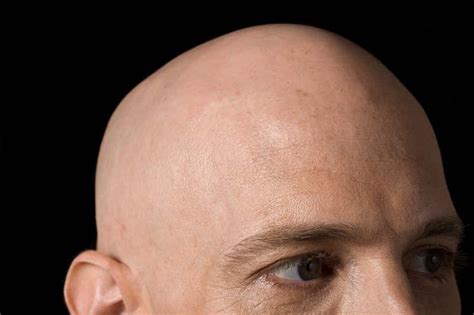 Is there an evolutionary benefit to being bald? | New Scientist