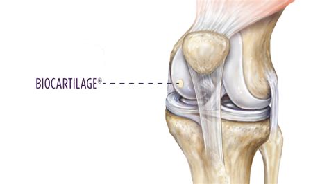 Knee Cartilage Injury Treatment Options | Summit Orthopedics