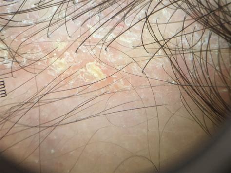 Mild Scalp Dermatitis