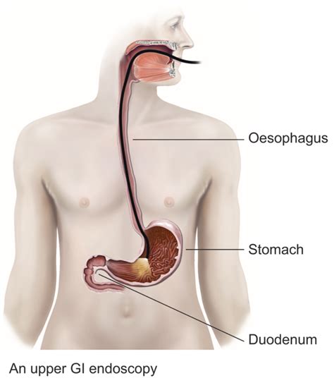 Upper-GI-endoscopy-procedure-diagram | Exeter Gut Clinic