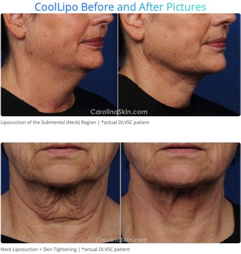 The Non-Surgical Neck Lift We All Want for Christmas | Neck lift, Neck ...