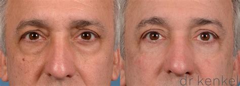 Eyelid Surgery in Dallas & Frisco, TX | Dr. Jeffrey Kenkel