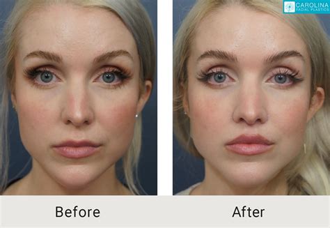 Is Permanent Lip Filler Really a Thing? - Carolina Facial Plastics