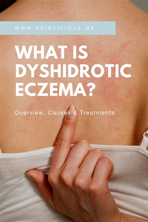 What is dyshidrotic eczema ? in 2021 | Eczema, Treatment