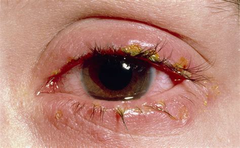 Eye Disease That Starts With M at Ashley Witt blog