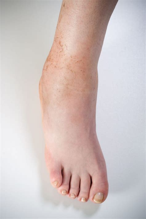 What Causes Foot Swelling? | RNV Podiatry