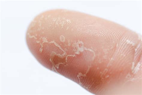 Peeling Skin on Hand and Fingers. Desquamation Stock Photo - Image of ...