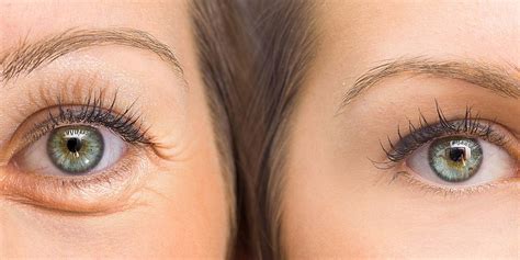 Under eye hollows Correction - Richmon Hill Clinic