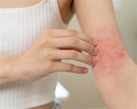 Flexural Eczema Triggers Understanding and How to Prevent Them