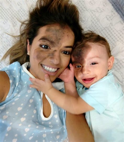 Mom Paints Large Birthmark on Her Face to Match Son: 'I Have Never ...