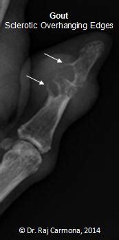 Gout: Overview of X-Ray Findings · RheumTutor