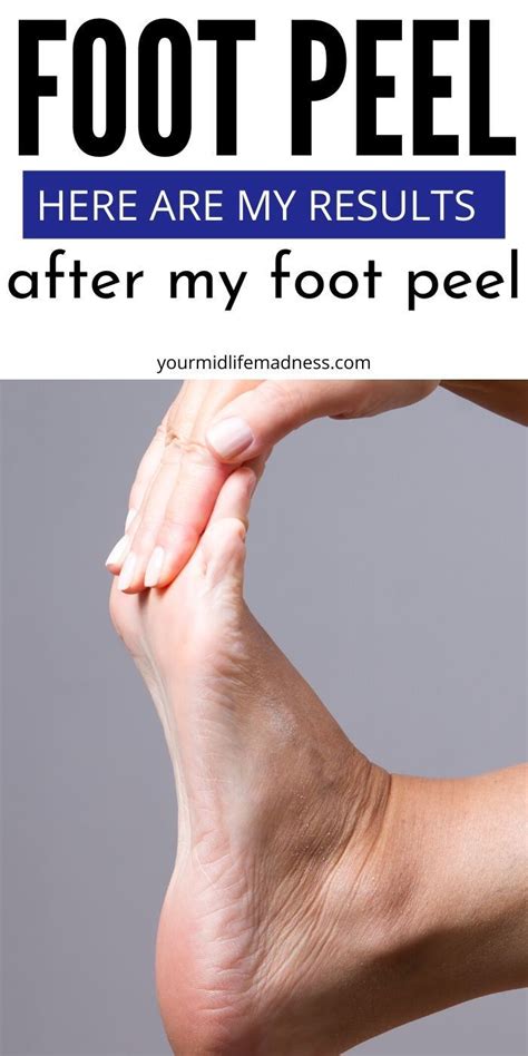 Home Kit Foot Peel Experience from Start to Finish | Foot peel, Baby ...