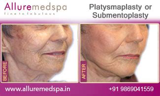 Platysmaplasty Mumbai | Platysmaplasty Surgery, Surgeon, Clinic, Cost ...