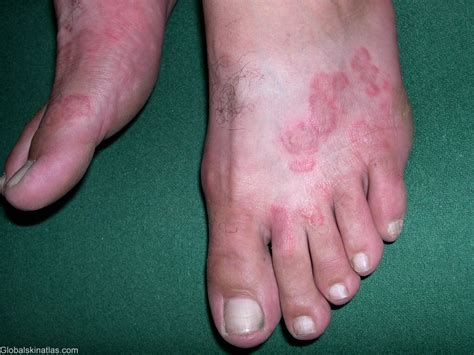 FUNGAL INFECTIONS OF THE SKIN - Podiatry HQ