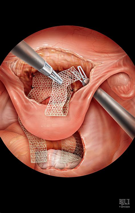 Laparoscopic sacrocolpopexy - Gaston - 2011 - BJU International - Wiley Online Library