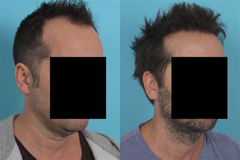 Hair Transplant Before & After Image| Case #26| Dr. Rawnsley