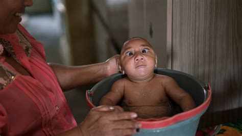 Some Brazilian Babies with Zika-related birth defects show eye problems