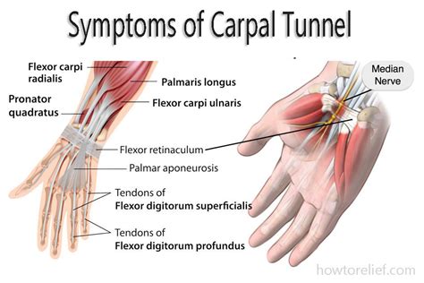 Carpal Tunnel: Symptom, Causes, Treatment & Exercise » How To Relief