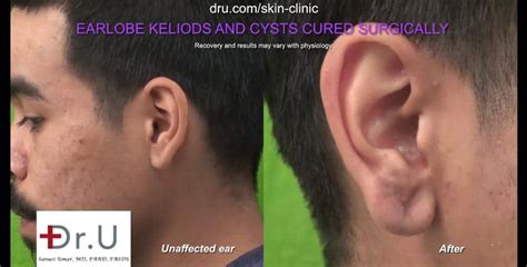 Video: Dr. U Surgically Removes Keloid Cyst From Earlobe | Long Beach