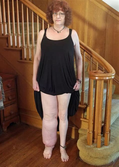 Woman left with 'elephant leg' after rare condition caused limb to swell uncontrollably - Irish ...