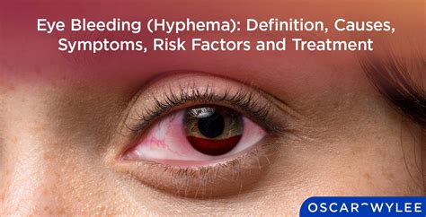 Eye Bleeding (Hyphema): Definition, Causes, Symptoms, Risk Factor and Treatment