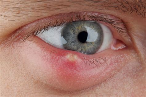 What is Chalazion? How is it treated? - Dr David Woo