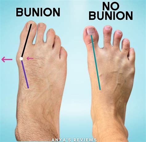 How To Help Your Bunions If You Don't Want Surgery | Anya's Reviews