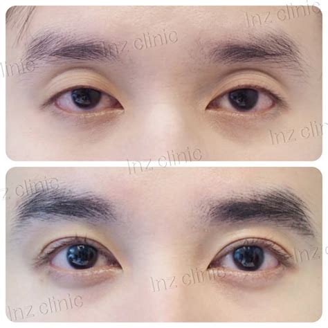 Korean Double Eyelids Surgery: Guide To Different Surgical Methods – Eunogo | atelier-yuwa.ciao.jp