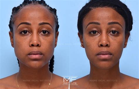 How To Get Defined/High Cheekbones With Cheek Filler in San Francisco | Mabrie Facial Institute
