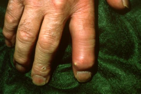 GOUT | Hand Surgery Source