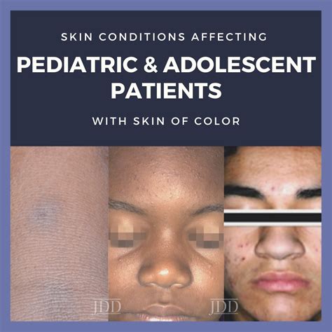 Skin Conditions in Pediatric & Adolescent Patients with Skin of Color - Next Steps in Dermatology