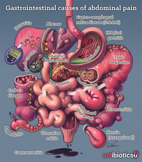 Gastrointestinal causes of abdominal pain, by Dr Cilein Kearns (artibiotics) Nursing School ...