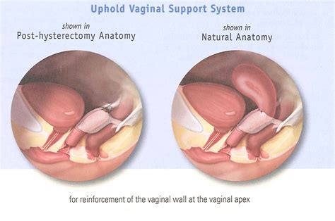 Is Pelvic Floor Repair Major Surgery | Viewfloor.co