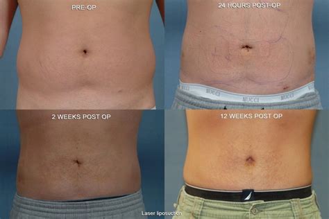 Laser Lipo for Men before and after performed by The Cosmetic Surgery & Rejuvenation Center ...