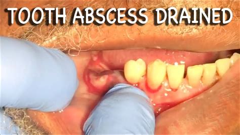 Infected Tooth Abscess Drained | Graphic⚠️ - YouTube