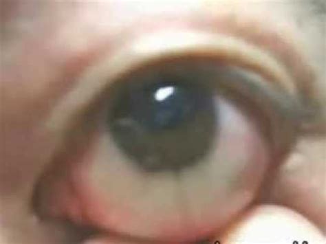 Eyeball Pop - YouTube