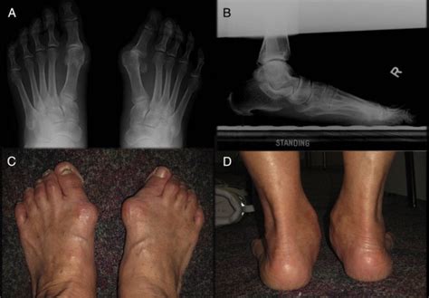 Spontaneous Subtalar Fusion: An Irreversible Complication of Subtalar Arthroereisis - The ...