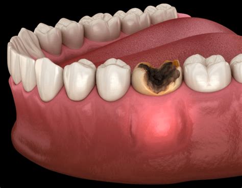 Abscess Drainage - Atlas Dental, Toronto Dentist