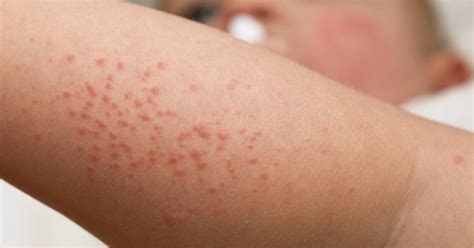 Causes Of Heat Rash Heat Hives Symptoms Treatment And Prevention 2020 ...