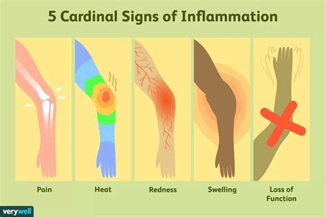 Signs of Inflammation | Signs of inflammation, Inflammation, Chronic ...