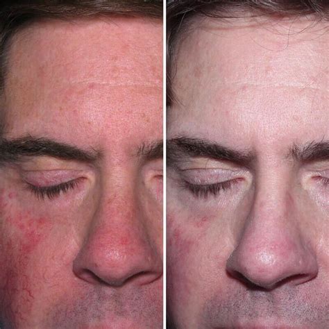 Rosacea Treatment | Before & After | Kingsway Dermatology