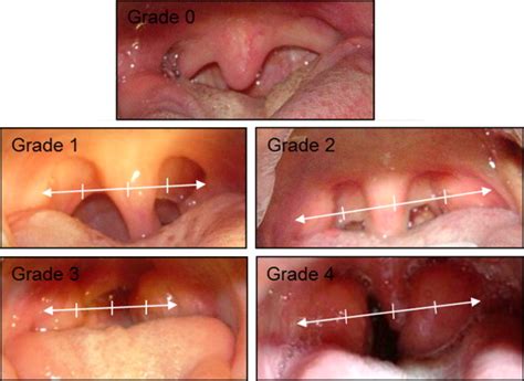 Influence of tonsillar grade on the dental arch measurements | Pocket Dentistry