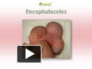 PPT – Encephaloceles: Symptoms, causes, diagnosis and treatment (1 ...