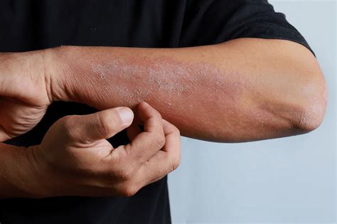 What Causes Eczema To Flare Up? - Aspire Dermatology