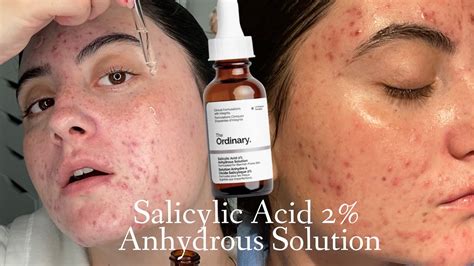 Salicylic Acid Acne Before And After