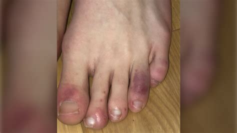 Pediatricians warned about 'COVID toes' in children infected with COVID-19 | CTV News