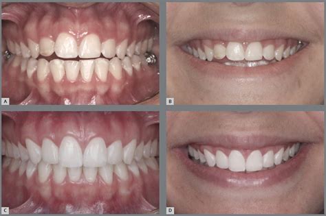 SciELO - Brasil - The smile arc: review and synthesis The smile arc: review and synthesis